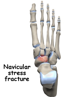 Navicular Stress Fracture New Health Advisor